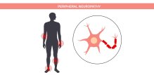 periferna neuropatija - uzroci