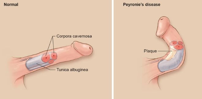 Peyronijeva bolest