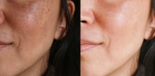 Melasma na licu