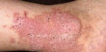 neurodermatitis
