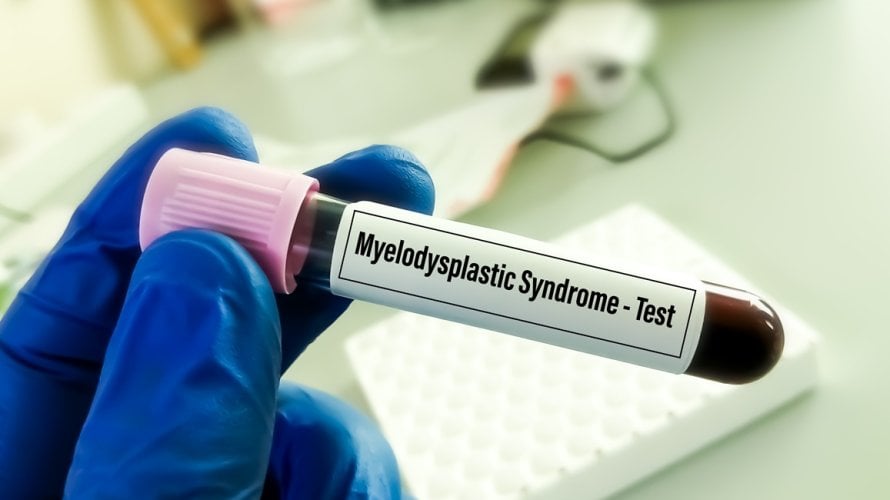 Mijelodisplastični sindrom