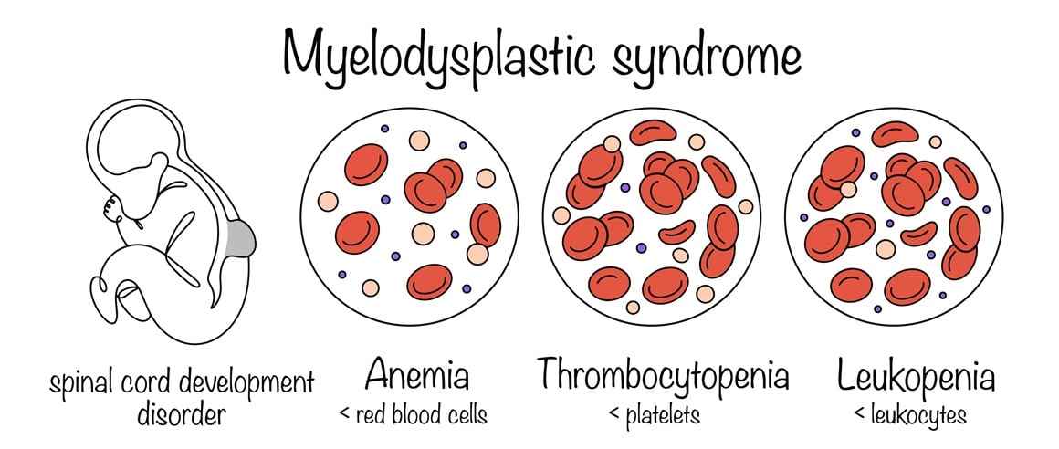 Mijelodisplastični sindrom - simptomi
