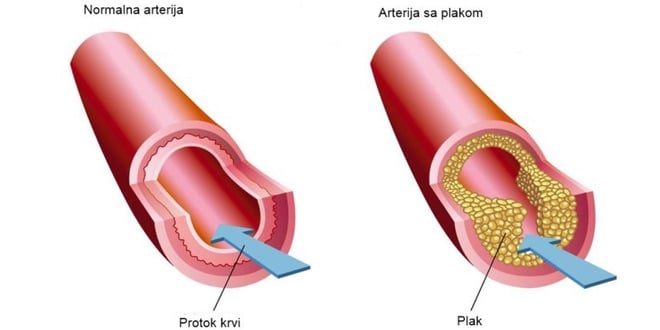 aterosklerozu i hipertenziju liječenje