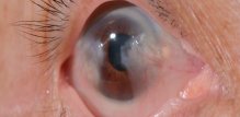 keratitis upala roznice