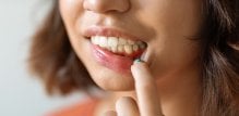 Upala desni i gingivitis