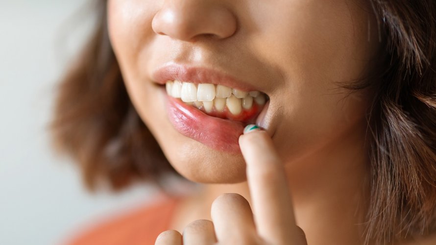 Upala desni i gingivitis