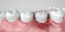 gingivitis - upala zubnog mesa