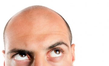 gubitak kose alopecija