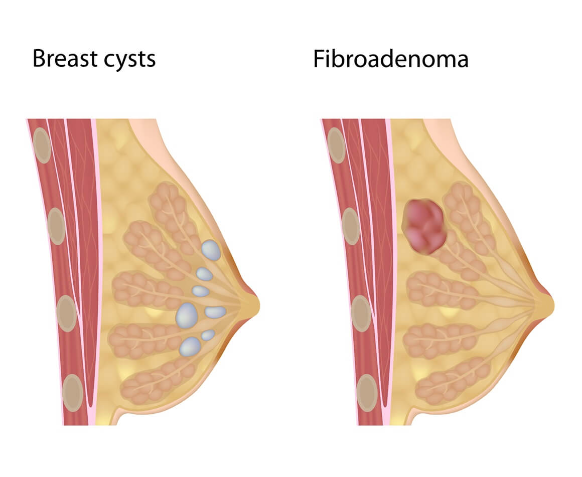 Fibroadenom dojke