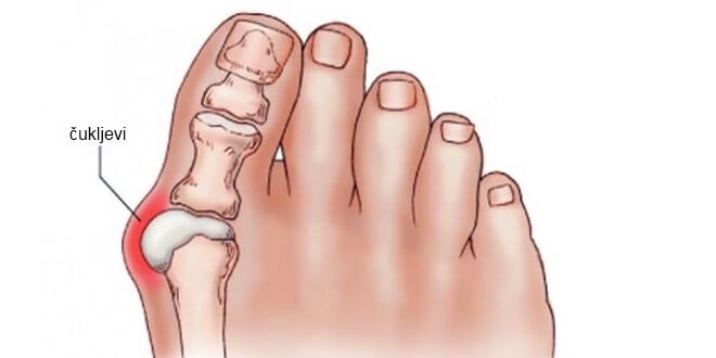 bol u zglobu nožnog prsta nakon artroplastike