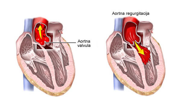 aortna regurgitacija