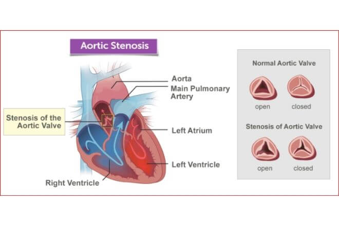 Prikaz aortne stenoze