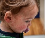 Šesta bolest (roseola ili trodnevna groznica)