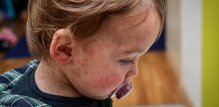 Šesta bolest (roseola ili trodnevna groznica)