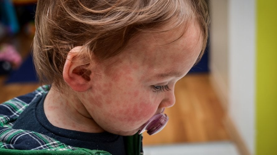 Šesta bolest (roseola ili trodnevna groznica)