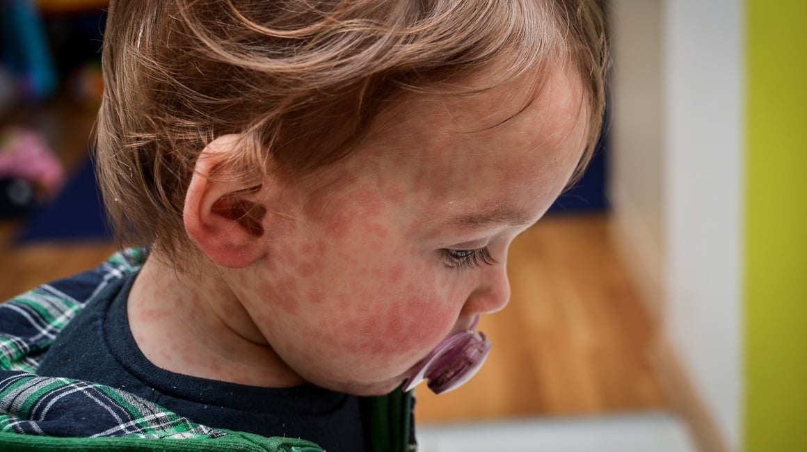 Šesta bolest (roseola ili trodnevna groznica)
