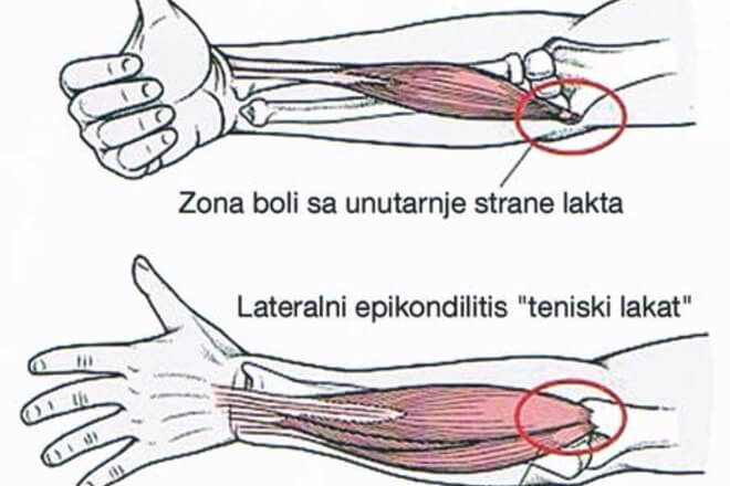 bol u zglob koljena klikova bolna nekroza zgloba kuka