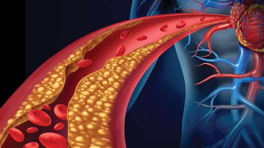 Povišene masnoće u krvi i ateroskleroza - PLIVAzdravlje