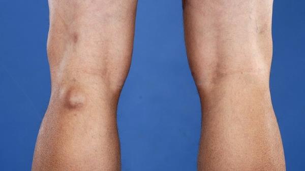 bolovi u zglobovima ispod koljena iza zajedničko liječenje nakon artroze od traume