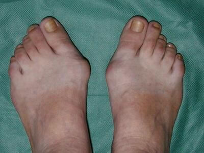 burzitis stopala 