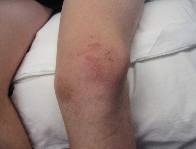 ozljeda koljena boli ispod koljena liječenje posttraumatske artroze zgloba zgloba