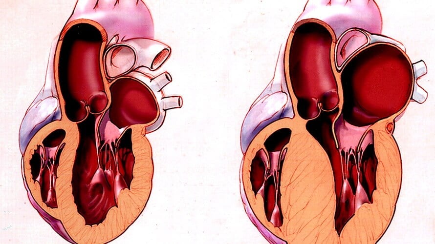 hipertrofija srca hipertenzije za liječenje hipertenzije i shishova