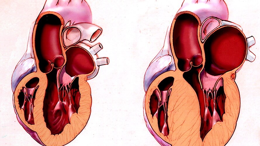 hipertroficna kardiomiopatija