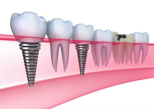 ilustracija-zubnih-implantata