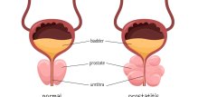 kronični nebakterijski prostatitis
