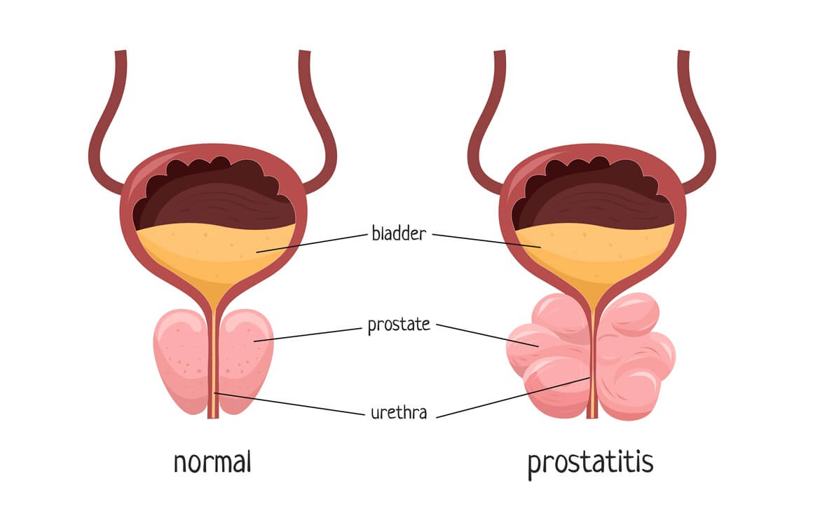 kronični nebakterijski prostatitis
