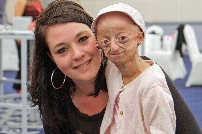 Progerija