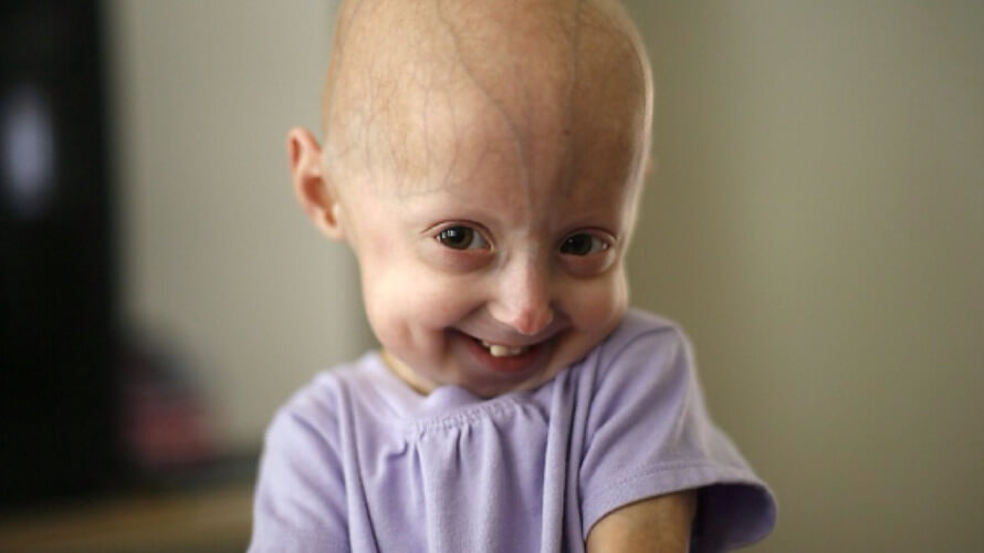 progerija