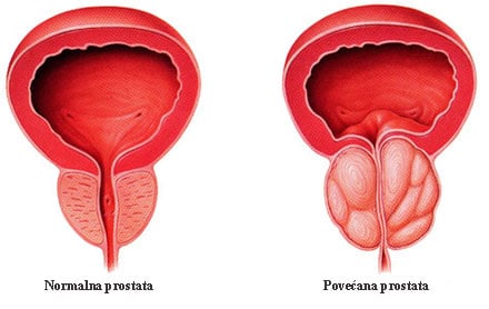 sukrovitsa a prostatitis alatt