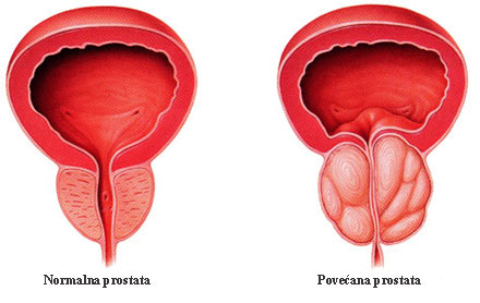 simptomi prostatitisa coffee and prostate cancer benefits