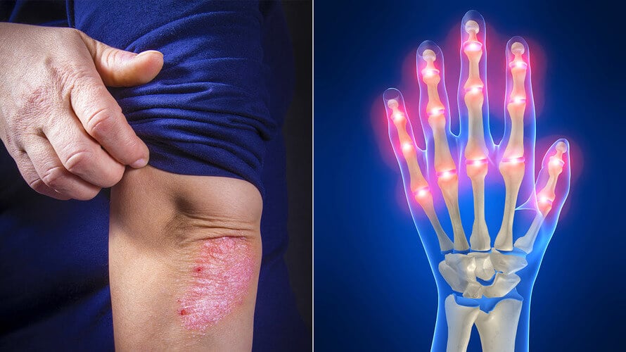 Ovih 8 simptoma ukazuju da možda bolujete od reumatoidnog artritisa