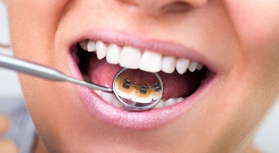 inkognito-metoda-ispravljanja-zuba