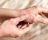 Psorijaza Koje dijelove tijela zahvaća i kako se liječi