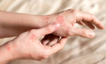Psorijaza Koje dijelove tijela zahvaća i kako se liječi