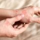 Psorijaza Koje dijelove tijela zahvaća i kako se liječi