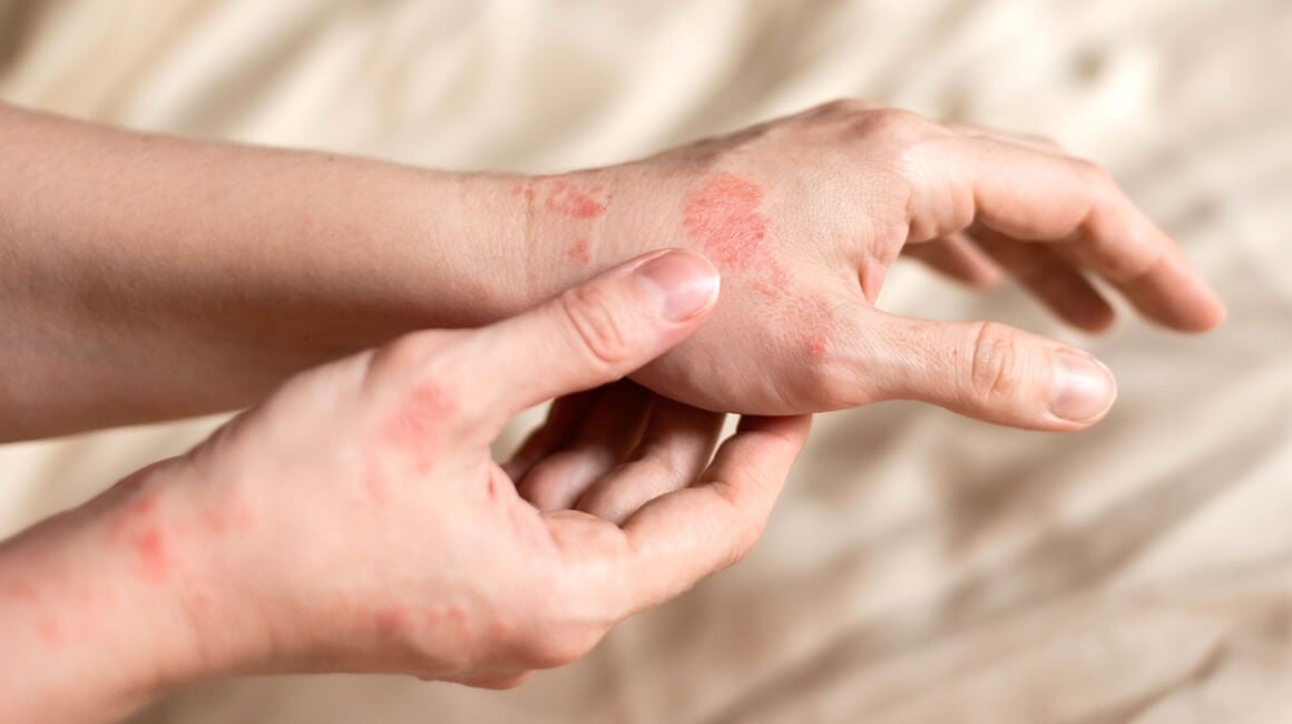 Psorijaza Koje dijelove tijela zahvaća i kako se liječi