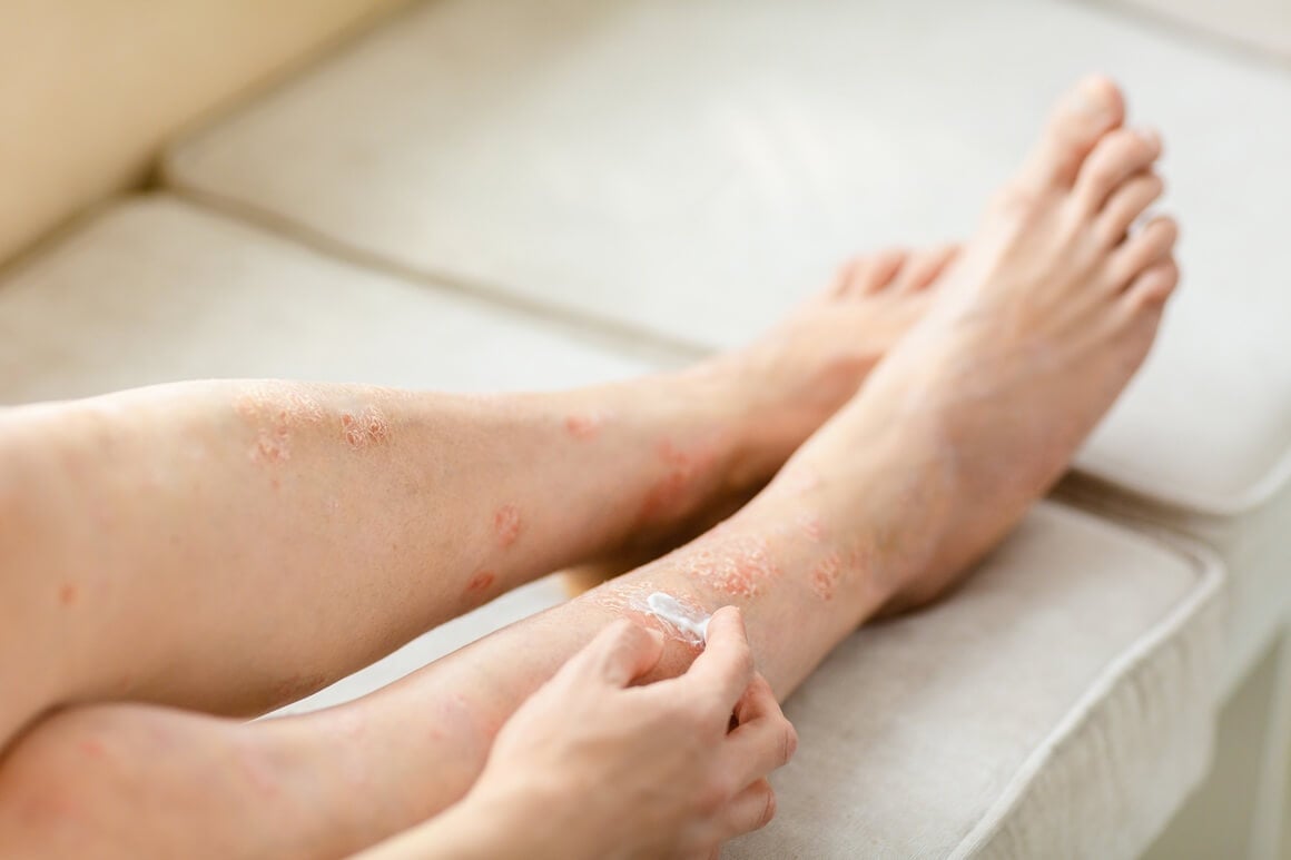 krema za psorijazu