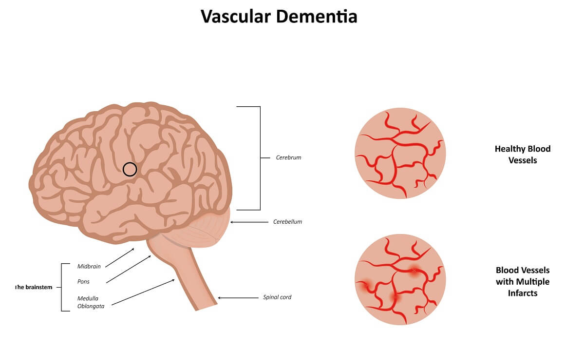 Vaskularna demencija