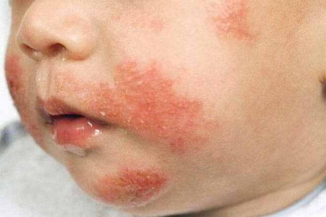 atopijski dermatitis beba 