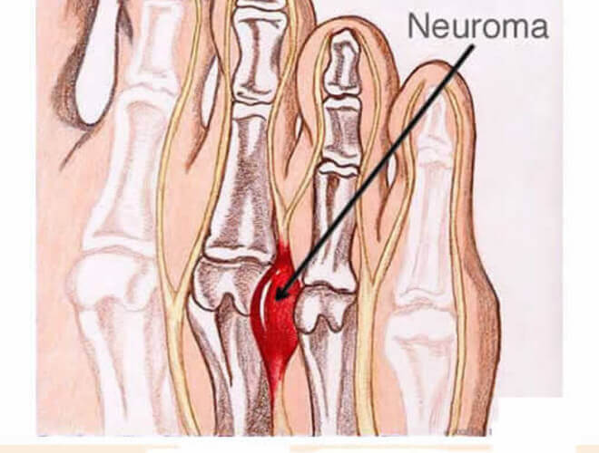 neuralgija bol u zglobovima i stopalima