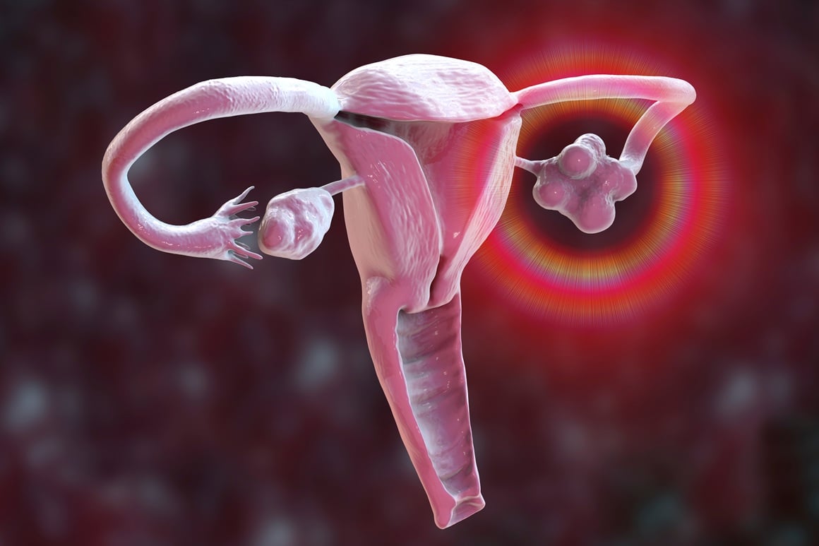 Cista na jajniku i izostanak menstruacije
