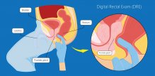Biopsija prostate - postupak