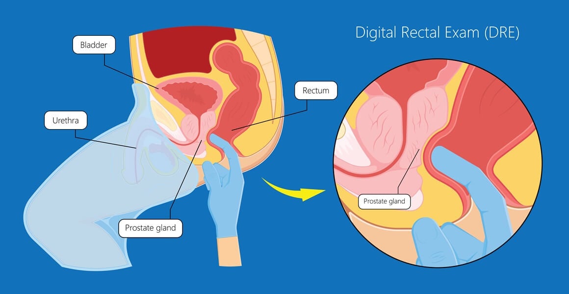 Biopsija prostate - postupak