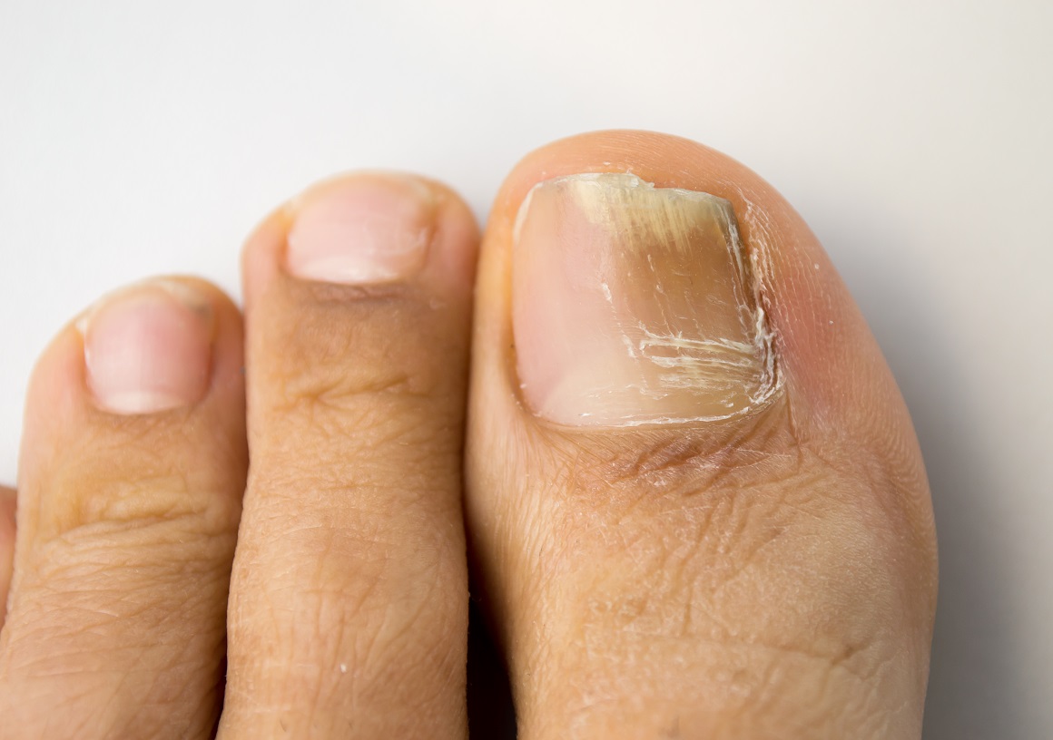 Gljivice na noktima su vrlo uporne i teško ih je liječiti