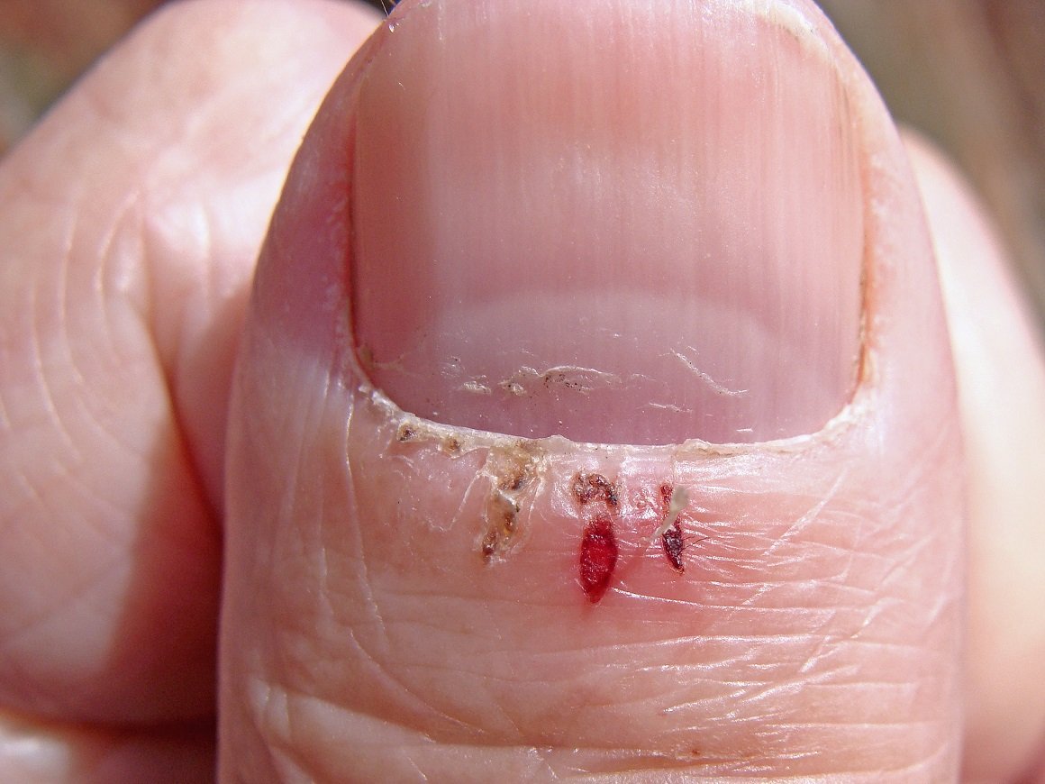 Zanoktica je uobičajeni naziv za upalu korijena nokta