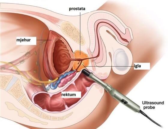 biopsija prostate supozitoare pentru prostatita vitol